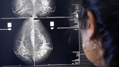La detecci&oacute;n temprana de c&aacute;ncer de mama posibilita curaci&oacute;n en 9 de cada 10 casos